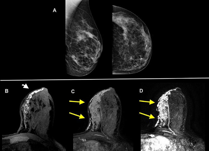 Figure 2.A 40-year-old female with dense breast and 4 months of pathological discharge from left nipple.