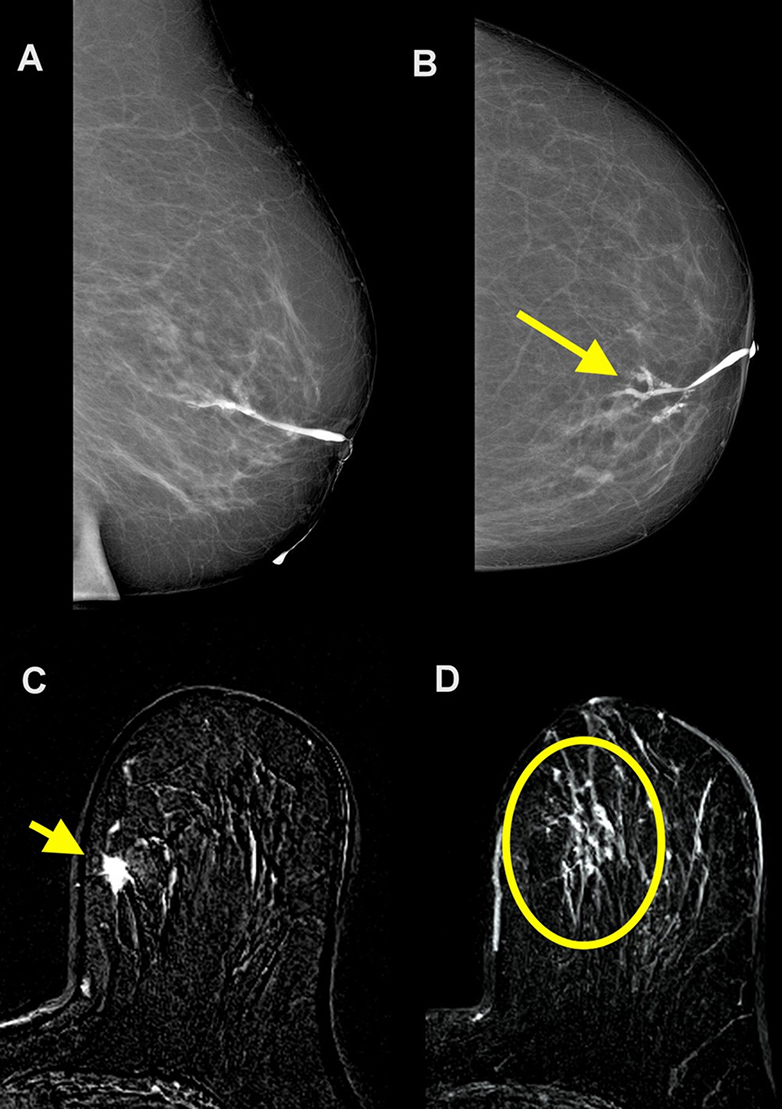 Figure 3. A 75-year-old female with 6 months of pathological discharge from the left nipple.